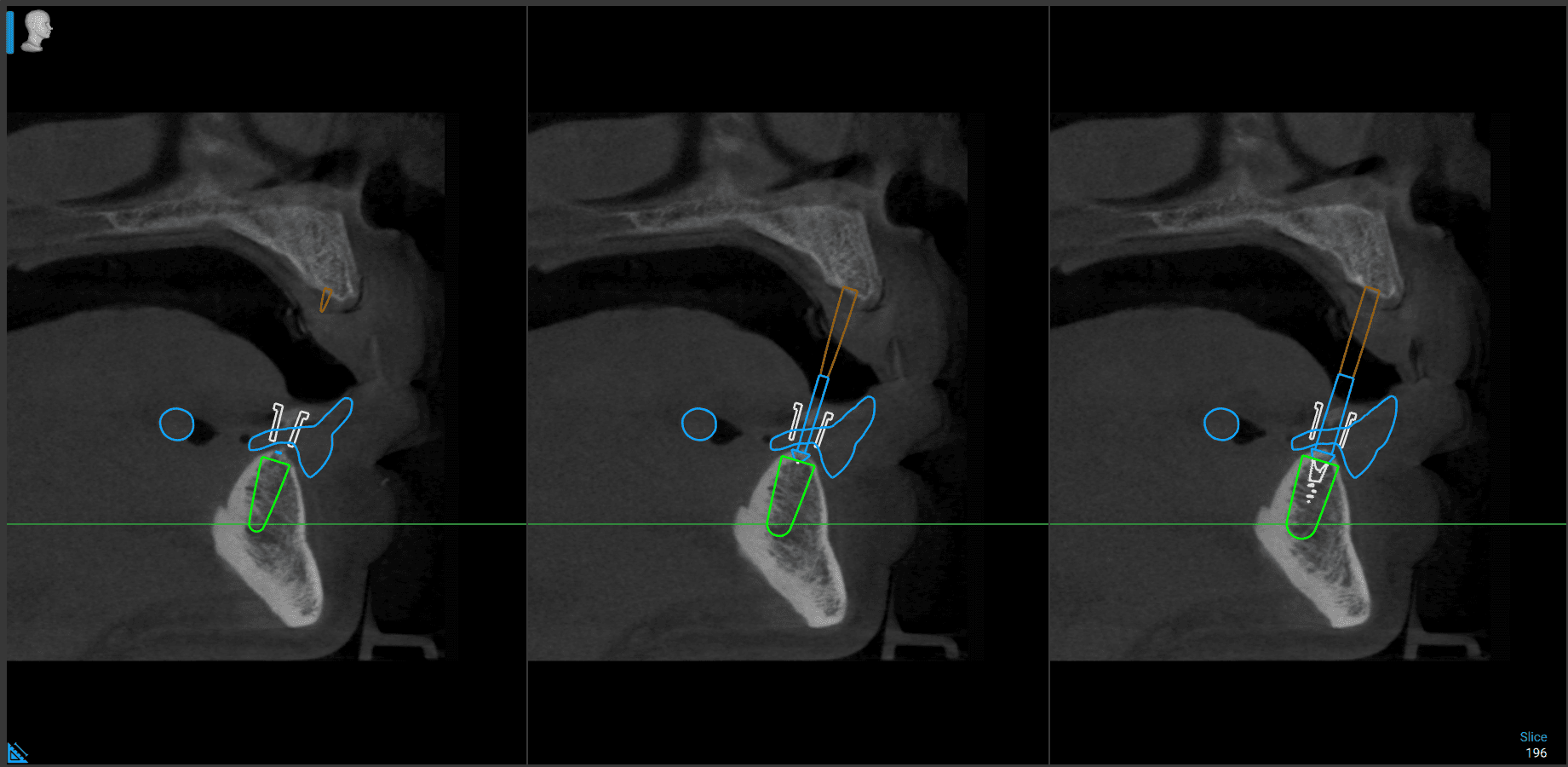 Digital Treatment Planning